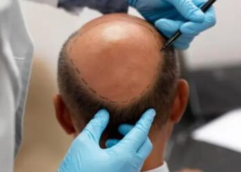 How Much Does A Hair Transplant Turkey Cost?