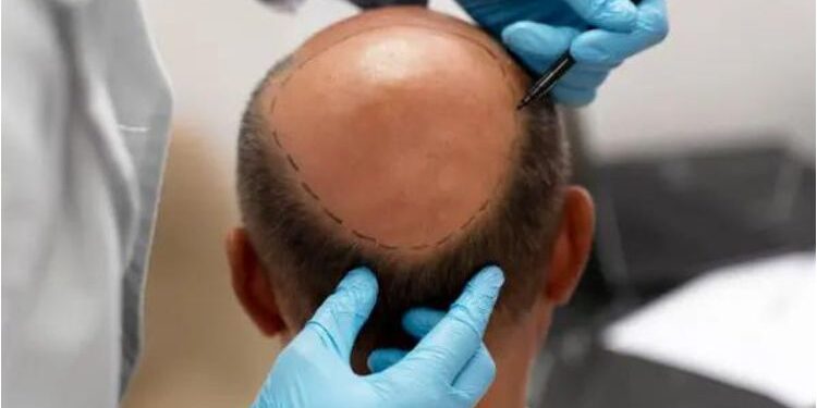 How Much Does A Hair Transplant Turkey Cost?